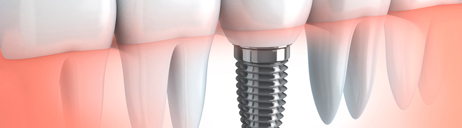 implantaciya