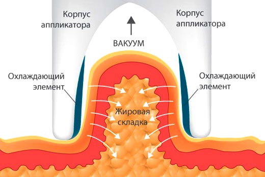 Результаты от криолиполиза